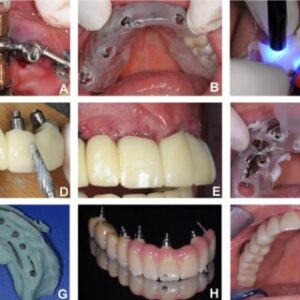 5 Types of Dental Implant Procedures